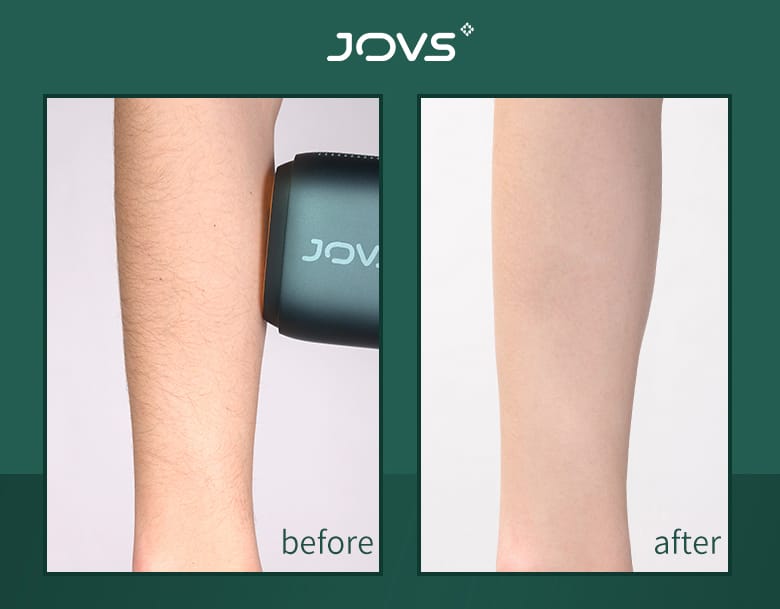 Living Today JOVS Venus Pro IPL(Intense Pulsed Light) Hair Remover
